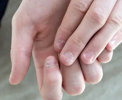 Маникюр на обгрызанные ногти без наращивания до и после (53 фото) -  картинки modnica.club
