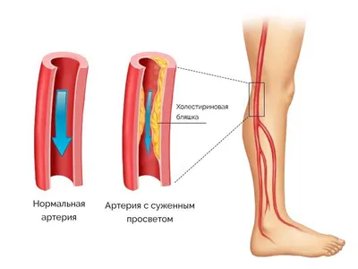 Атеросклероз и эндартериит | Клиника доктора Шишонина