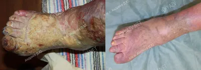 Атеросклероз нижних конечностей – облитерирующий и хронический - причина  онемения ног.