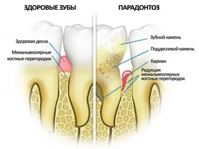 Отличия пародонтоза и пародонтита – клиника МАЙ