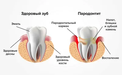 Стоматология Ориен-дента - Пародонтит и пародонтоз — слова похожи, а вот  заболевания разные. Объясняю разницу ниже, жмите ❤️ . Пародонт — это единая  система тканей, окружающих зуб. В нее входят дёсны, костная