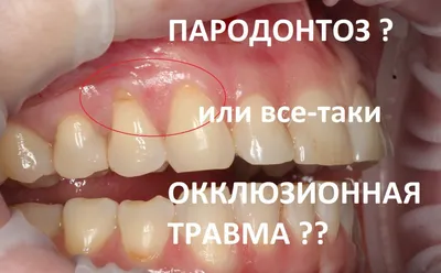 Лечение пародонтоза у метро Орехово в Москве — цены в стоматологической  клинике «Medical Star»