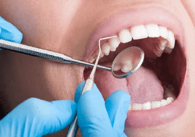 Ош стоматолог Ортодонт Брекет - Лечение пародонтоза. Объем  стоматологической помощи пациентам с пародонтозом зависит от стадии  заболевания. Пациенты не замечают начальных симптомов болезни и обращаются  к специалисту уже в запущенных случаях. В