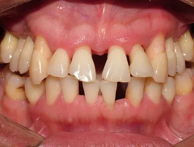 Пародонтоз – статьи стоматологической клиники «Medical Star»
