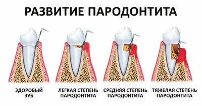 Лечение Пародонтита и Пародонтоза | Denta Vita [Новые Услуги 2020]