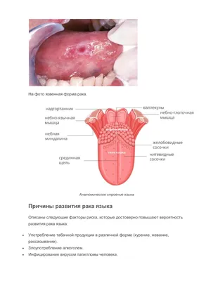 Определение прогноза эффективности лечения плоскоклеточного рака полости  рта и глотки - YouTube