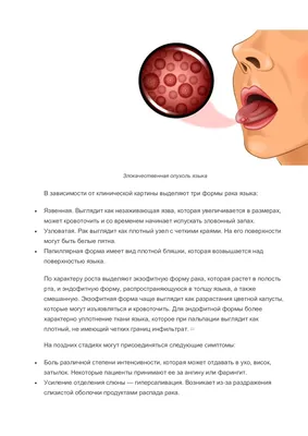 Рак языка: симптомы, диагностика, лечение, стадии и профилактика онкологии