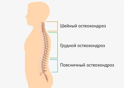 Лечение шейного остеохондроза в СПб – клиника «СмартМед»