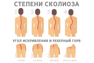 S-Образный сколиоз 1-2-3 степени, причины, лечение грудо-поясничного отдела  позвоночника