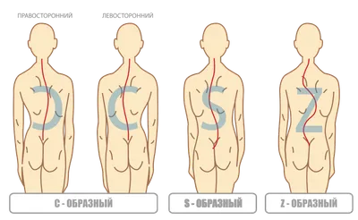 СКОЛИОЗ позвоночника 1, 2, 3 и 4 степени у детей и взрослых - симптомы,  причины, диагностика | Mednavigator.ru | Дзен