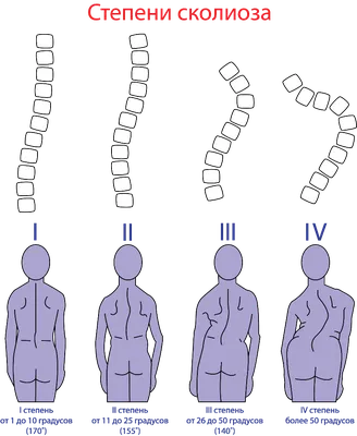 S образный сколиоз: особенности искривления грудо-поясничного отдела и  методы коррекции