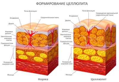 🔥🔥🔥Целлюлит - в Хирургии это... - Косметология без границ | Facebook