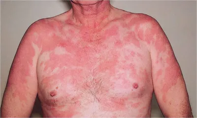 Случай генерализованного поствакцинального осложнения после ревакцинации  БЦЖ. Туберкулез кожи и подкожной жировой клетчатки, стадия рубцевания