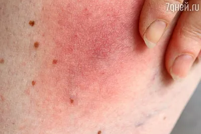 Аллергия на укусы насекомых: симптомы, как распознать и лечить