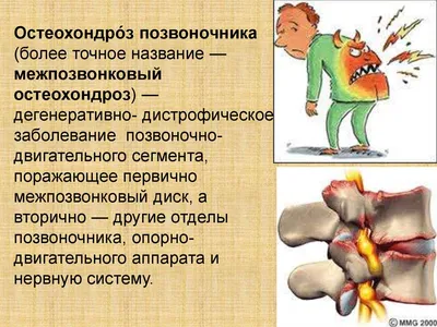 Остеохондроз позвоночника - симптомы и лечение | Семейный доктор