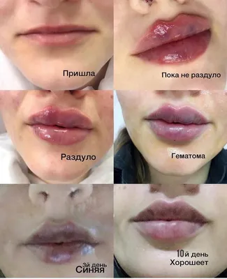 Увеличение губ за 5000 ₽. Клиника Vesna. Красноярск.