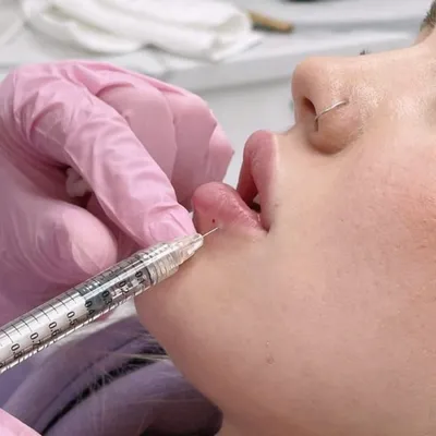 Увеличение губ (хейлопластика) | Клиника доктора Куприна