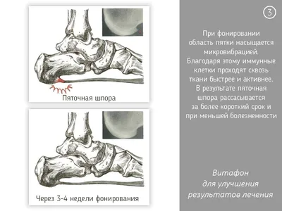 Витафон при пяточной шпоре