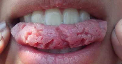 Методы профгигиены полости рта