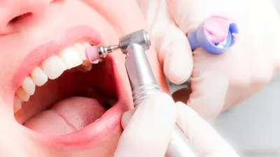 Виды и отличия имплантации зубов - Cтоматология Май
